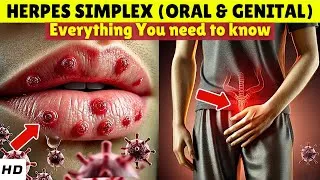 Thumbnail: Herpes Simplex Uncovered: Transmission, Why It Never Goes Away, Symptoms, Treatment & Home Remedies