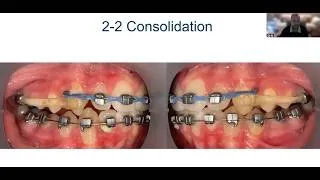 Thumbnail: Dr. Ragan & Carriere Motion Pro: The Drop-In Difference Clinical Applications for Class II & III