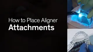 Thumbnail: How to Place Attachments | Smilers® Aligners