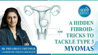 Thumbnail: The invisible fibroid: how we saw and removed a type 3 myoma by HTRS
