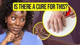 Thumbnail: Psoriasis Symptoms You Should Never Ignore