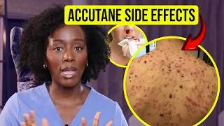 Thumbnail: Don’t Start Isotretinoin(Roaccutane/Accutane) Until You Know This!