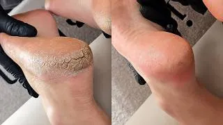 Thumbnail: The Deepest Cracked Heels I've Ever Fixed