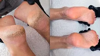 Thumbnail: Breathing Life Back Into Feet She's Hidden For Years