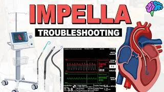 Thumbnail: How to troubleshoot an Impella!