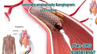 Thumbnail: Angiogram pcs coding | IP DRG coding 
