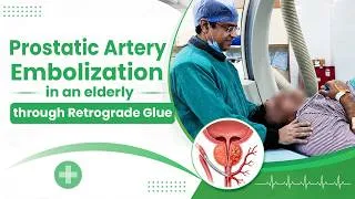 Thumbnail: Prostatic Artery Embolization in an elderly through retrograde glue.