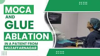 Thumbnail: Moca and Glue Ablation in a patient from Muzzafarnagar.