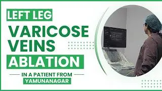 Thumbnail: Left Leg Varicose Veins Moca Ablation in a patient from Yamunanagar.