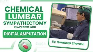Thumbnail: chemical Lumbar Sympathectomy in a patient with digital amputation.