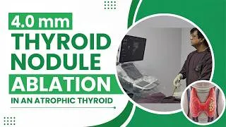 Thumbnail: 4.0 mm Thyroid nodule Ablation in an Atrophic Thyroid.