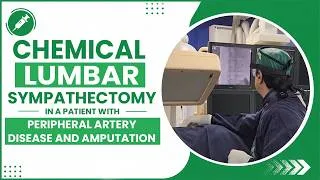Thumbnail: Chemical Lumbar Sympathectomy in a patient with Peripheral Artery Disease and Amputation.