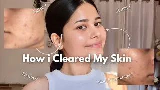 Thumbnail: *MY HONEST* OILY ACNE PRONE SKINCARE ROUTINE + LIFESTYLE TIPS🫧