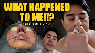 Thumbnail: WHAT HAPPENED TO ME? | RHINOPLASTY Journey (Real Experience)