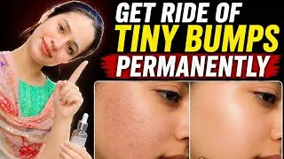 Thumbnail: Clear Face in 7 Days! 😱 Get Rid of Tiny Bumps At Home