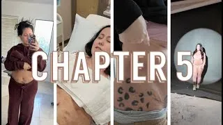 Thumbnail: Tummy Tuck Journey - Ch. 5 Four & Five Week Post-Op