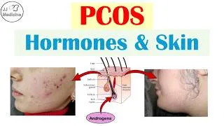 Thumbnail: PCOS & Your Skin: 4 Signs Your Hormones Are Out of Control