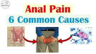 Thumbnail: 6 Common Causes of Anal (Rectal) Pain That You Should Know