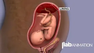 Thumbnail: Placenta Accreta