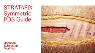 Thumbnail: STRATAFIX Symmetric PDS Antibacterial Barbed Suture Technique | J&J MedTech