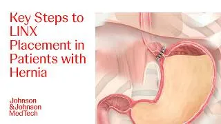 Thumbnail: LINX Procedure on a Patient with Small Hiatal Hernia | J&J MedTech