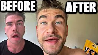 Thumbnail: I AM NO LONGER PARALYZED - HOW I "CURED" RAMSEY HUNT SYNDROME Joel Hansen