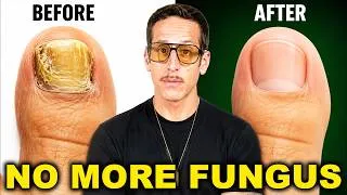Thumbnail: Eliminate Toenail Fungus FAST — Do This Every Night