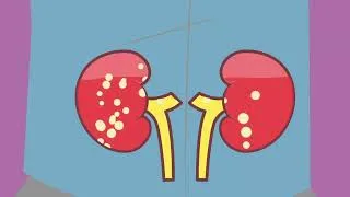 Thumbnail: FSGS in Focus: What is FSGS?