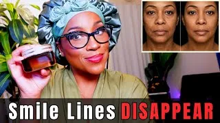 Thumbnail: 7 Products I Use to Get Rid of Smile Lines