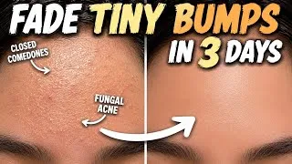 Thumbnail: Remove TINY BUMPS FOR Teenage in 3 Days✨WASHING FACE WITH SHAMPOO?🫧😱