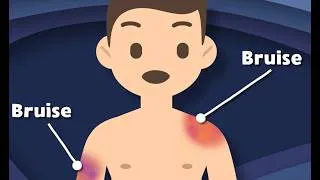 Thumbnail: How Do Bruises Happen… And More Fun Anatomy Lessons!