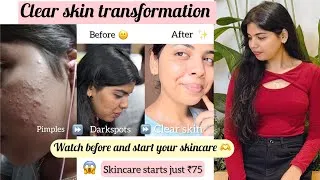 Thumbnail: From Painful Cystic Acne to Glowing Skin✨|How I Cleared My Acne & Darkspots with simple skincare😮