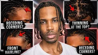 Thumbnail: If Your Hairline Is Receding, Watch This Before You Give Up (Black Men)