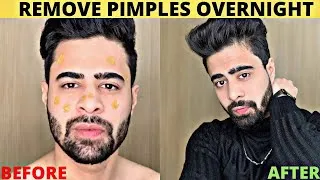 Thumbnail: How To Remove Pimples Overnight |Teenager|| Adults| | Acne Treatment |