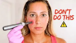 Thumbnail: DIY MICRONEEDLING AT HOME - DO'S & DON'TS!