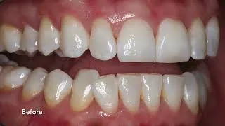 Thumbnail: Smile Make-Over