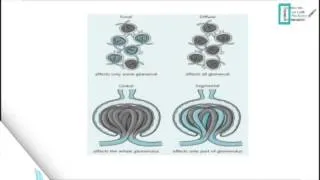 Thumbnail: Glomerulonephritis