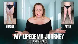 Thumbnail: My Lipedema Surgery Journey Part 3