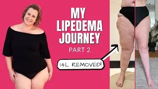 Thumbnail: LIPEDEMA Leg Surgery Part 2: Back in Madrid