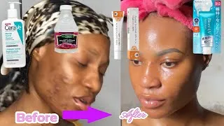 Thumbnail: HOW I CLEARED MY SKIN AFTER 2 YEARS