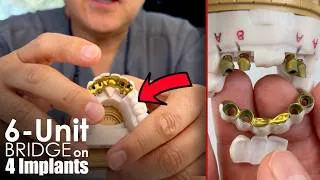 Thumbnail: How to Make an Implant Long-Span Bridge Pontic?