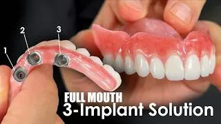Thumbnail: Incredible Solution for Full-Mouth Implants on Only 3 Implants
