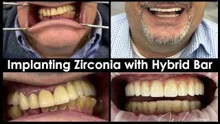 Thumbnail: Implanting Full-Mouth Zirconia with Hybrid Bar in Patient's Mouth