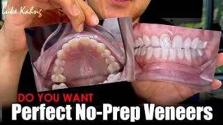 Thumbnail: Do You Want a Perfec No-Prep Veneer Process?