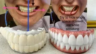 Thumbnail: Thin Ceramic full-Mouth Implants Bridge Perfectly Executed