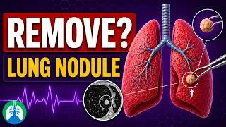 Thumbnail: Lung Nodule Removal - What to Know Before, During, and After