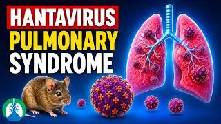 Thumbnail: Hantavirus Pulmonary Syndrome (HPS): Symptoms, Causes, and Prevention