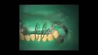 Thumbnail: Fiber-Splint Ortho Evolution - Case Clinnic by Vitalcom