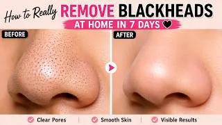Thumbnail: Blackhead Removal Guide|How to Really Remove Blackheads at Home in 7 Days 🖤|#makeulreels |#makeup