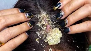 Thumbnail: ASMR with Scalp Scratching #DKMO38006